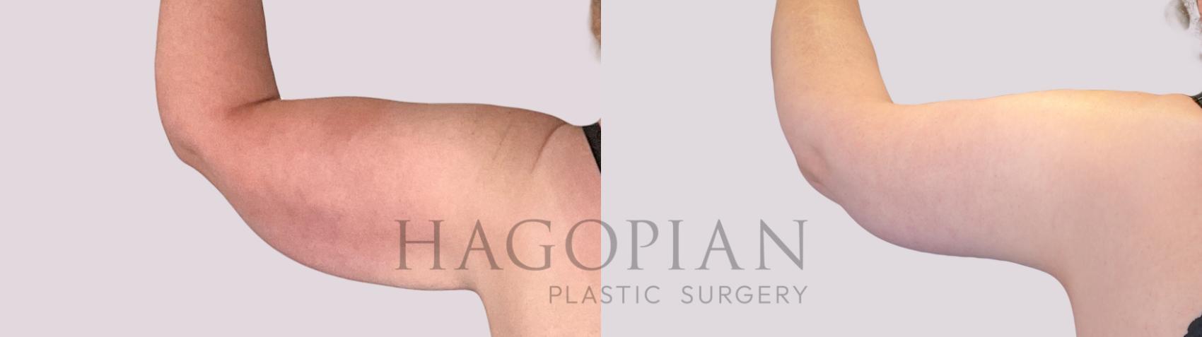 Before & After Arm Lift Case 269 Back Left View in Atlanta, GA