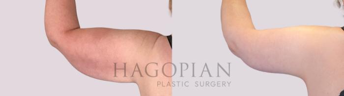 Before & After Arm Lift Case 269 Back Left View in Atlanta, GA