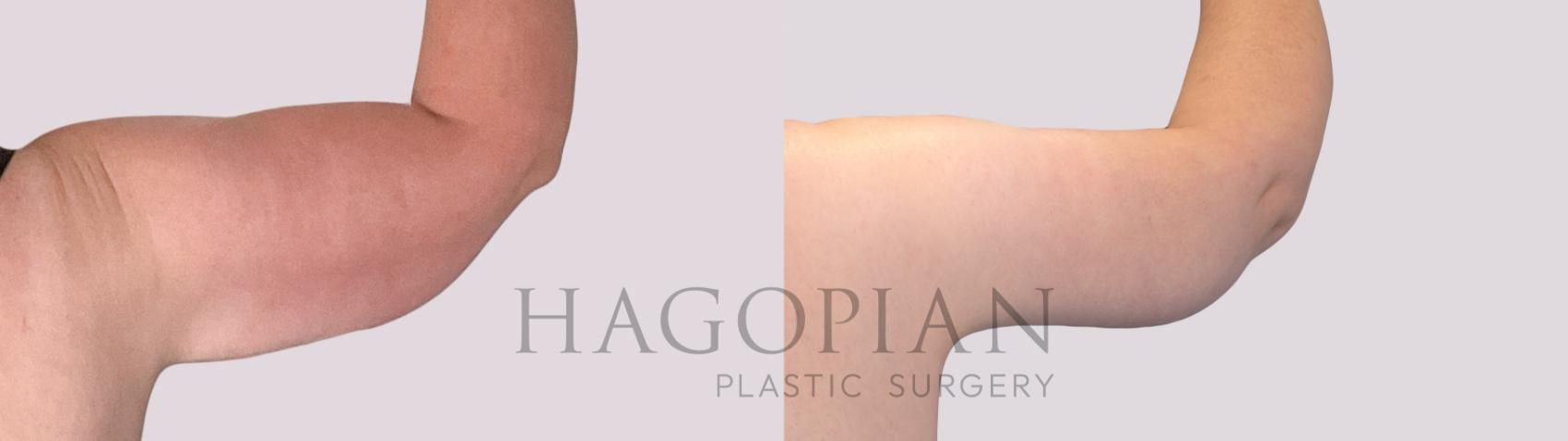 Before & After Arm Lift Case 269 Back Right View in Atlanta, GA