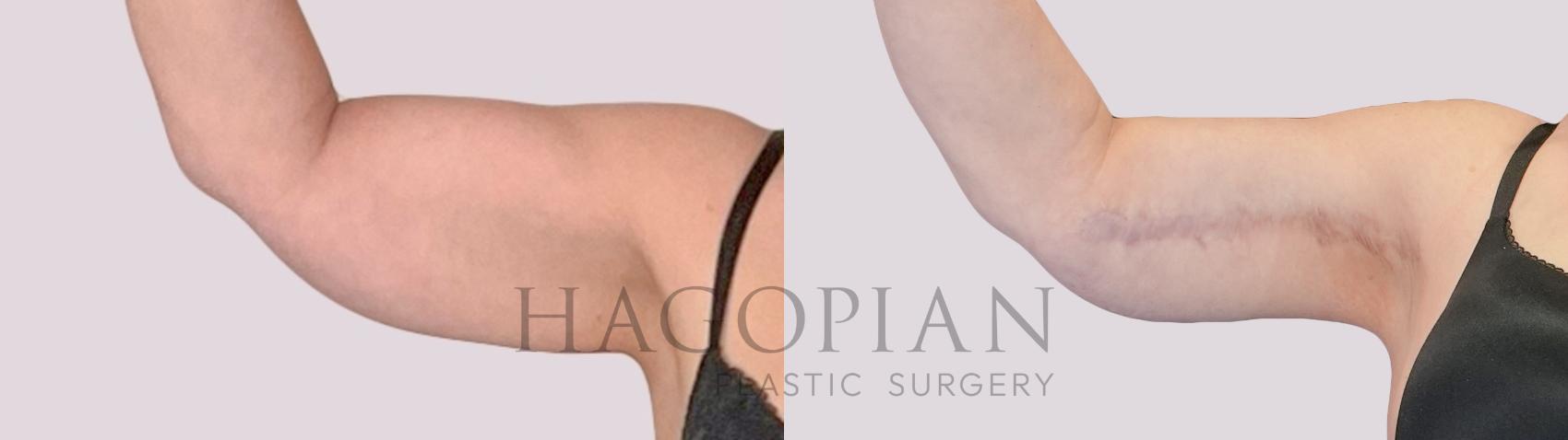 Before & After Arm Lift Case 269 Front Left View in Atlanta, GA