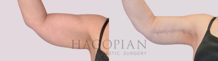 Before & After Arm Lift Case 269 Front Left View in Atlanta, GA