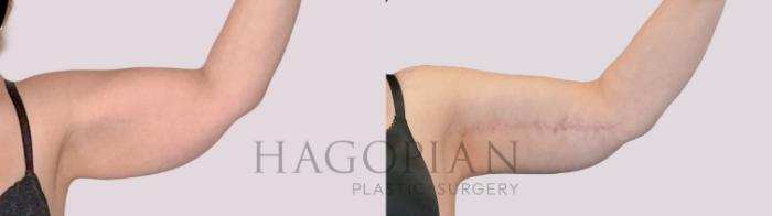 Before & After Arm Lift Case 269 Front Right View in Atlanta, GA