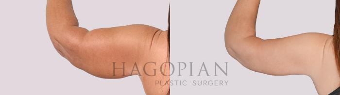 Before & After Arm Lift Case 276 Back Left View in Atlanta, GA