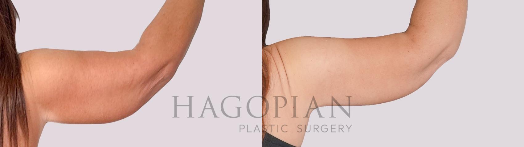 Before & After Arm Lift Case 276 Back Right View in Atlanta, GA