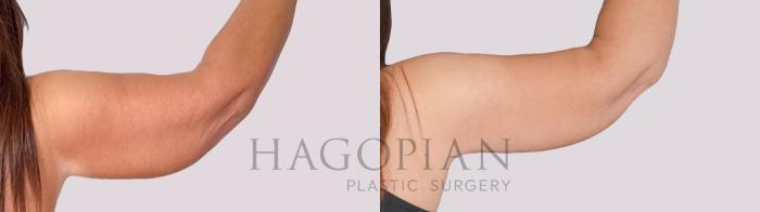 Before & After Arm Lift Case 276 Back Right View in Atlanta, GA