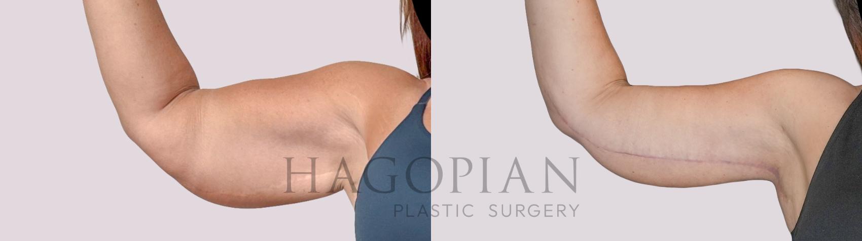 Before & After Arm Lift Case 276 Front Left View in Atlanta, GA