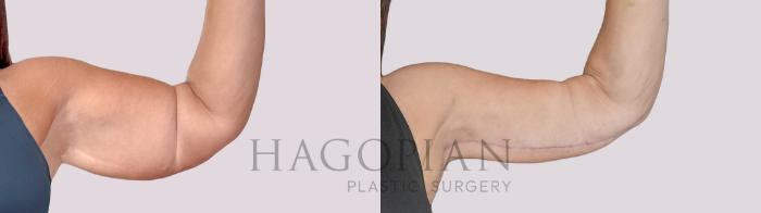 Before & After Arm Lift Case 276 Front Right View in Atlanta, GA