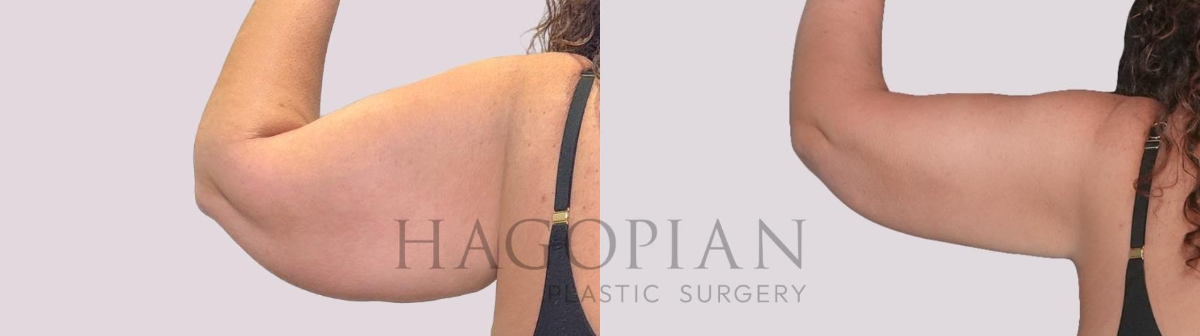 Before & After Arm Lift Case 277 Back Left View in Atlanta, GA