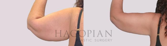 Before & After Arm Lift Case 277 Back Left View in Atlanta, GA