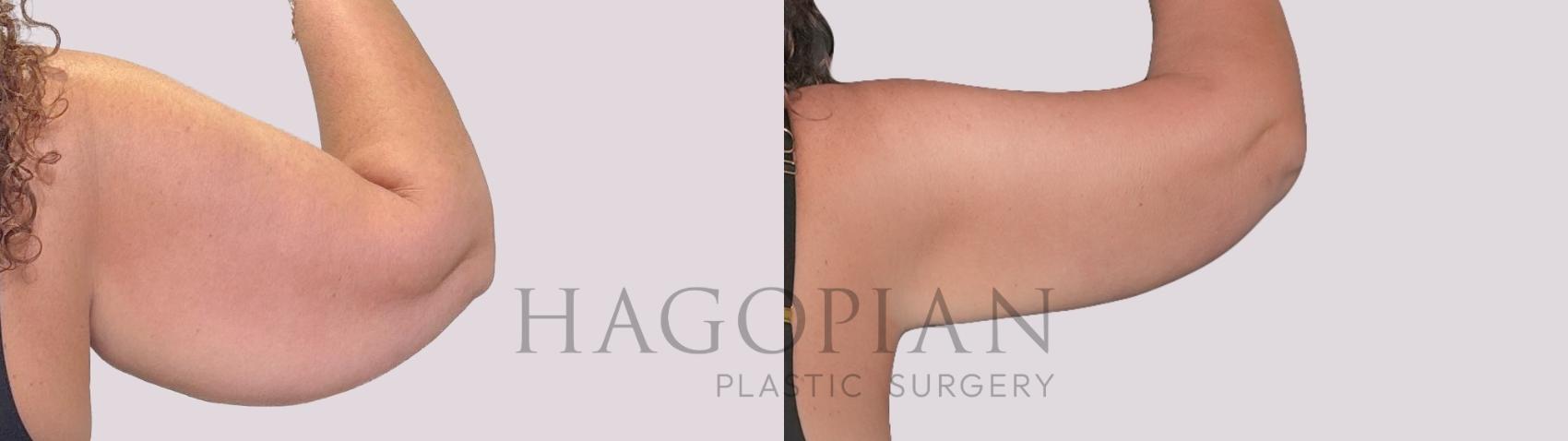 Before & After Arm Lift Case 277 Back Right View in Atlanta, GA