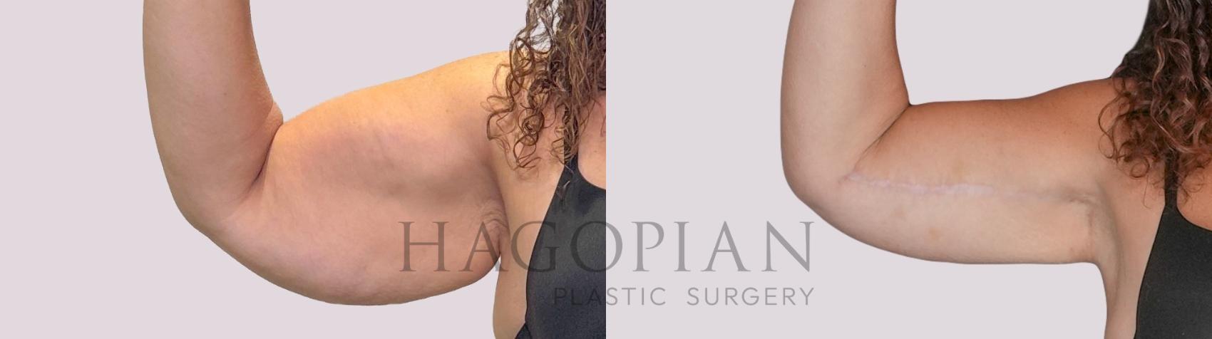 Before & After Arm Lift Case 277 Front Left View in Atlanta, GA