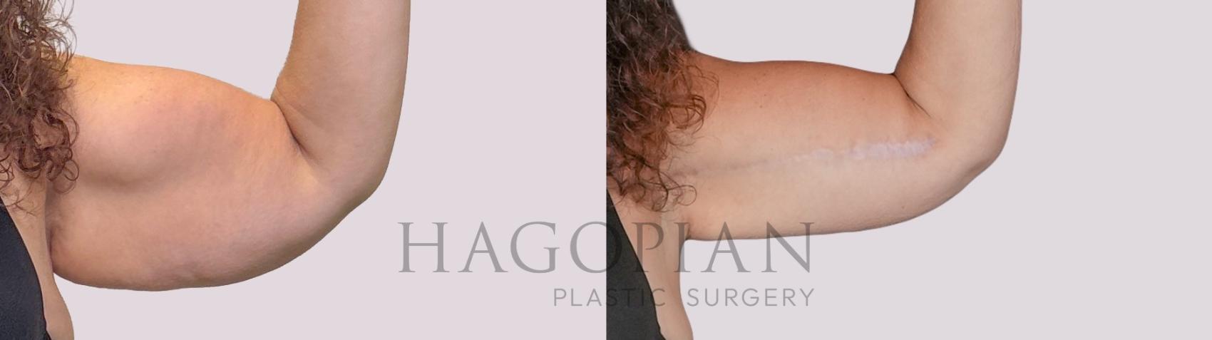Before & After Arm Lift Case 277 Front Right View in Atlanta, GA