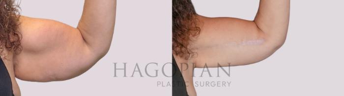 Before & After Arm Lift Case 277 Front Right View in Atlanta, GA