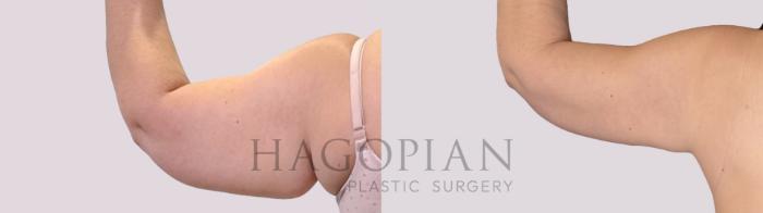 Before & After Arm Lift Case 284 Back Left View in Atlanta, GA
