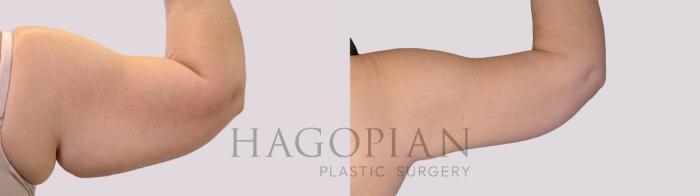 Before & After Arm Lift Case 284 Back Right View in Atlanta, GA