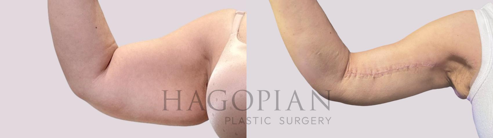 Before & After Arm Lift Case 284 Front Left View in Atlanta, GA