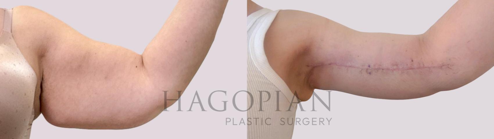 Before & After Arm Lift Case 284 Front Right View in Atlanta, GA