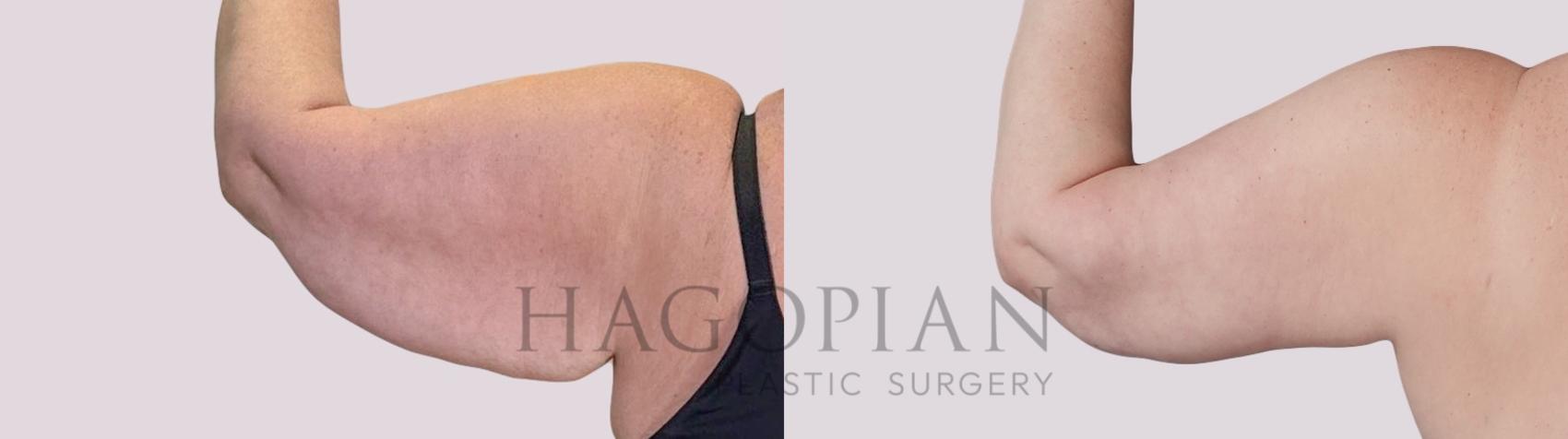 Before & After Arm Lift Case 286 Back Left View in Atlanta, GA