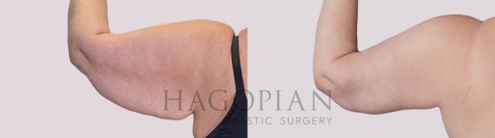 Before & After Arm Lift Case 286 Back Left View in Atlanta, GA