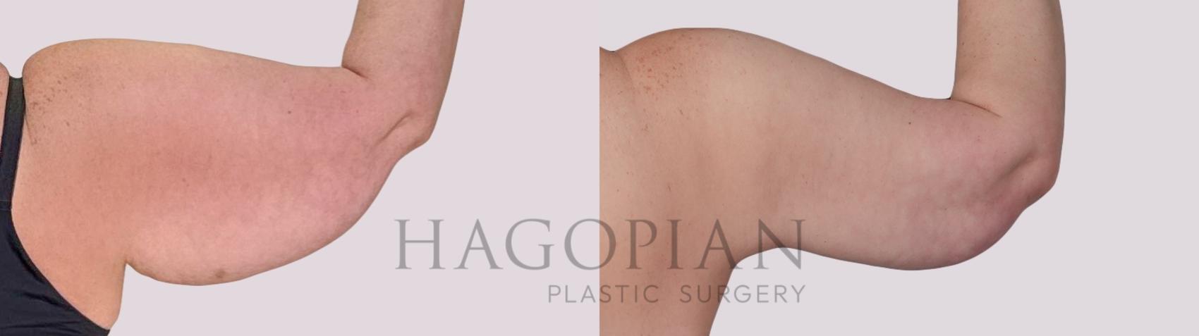 Before & After Arm Lift Case 286 Back Right View in Atlanta, GA