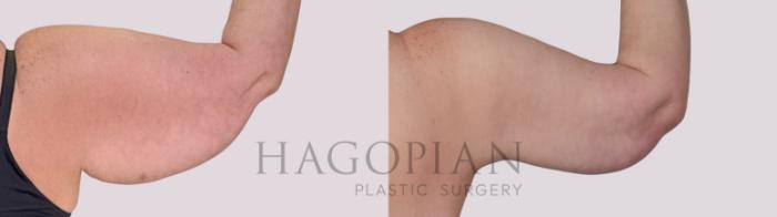 Before & After Arm Lift Case 286 Back Right View in Atlanta, GA