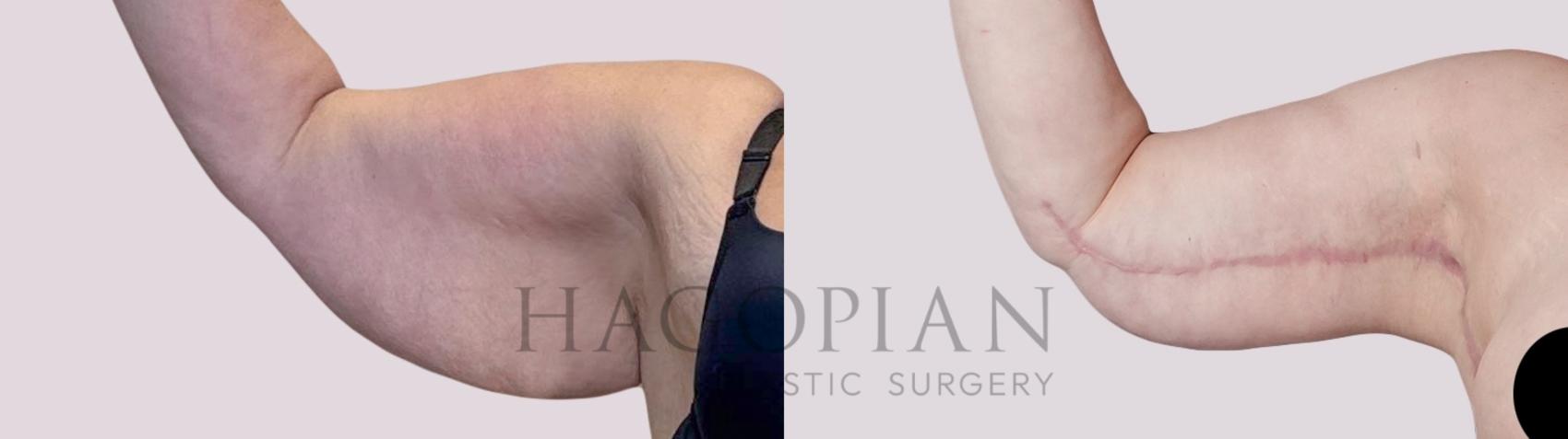 Before & After Arm Lift Case 286 Front Left View in Atlanta, GA
