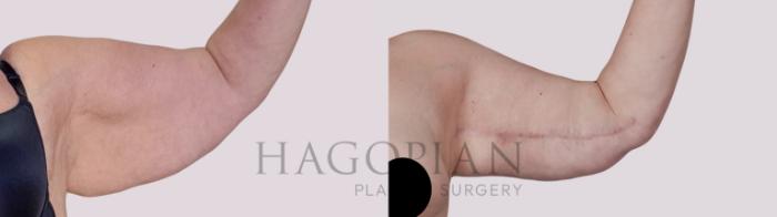 Before & After Arm Lift Case 286 Front Right View in Atlanta, GA