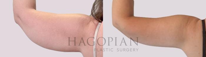 Before & After Arm Lift Case 290 Back Left View in Atlanta, GA