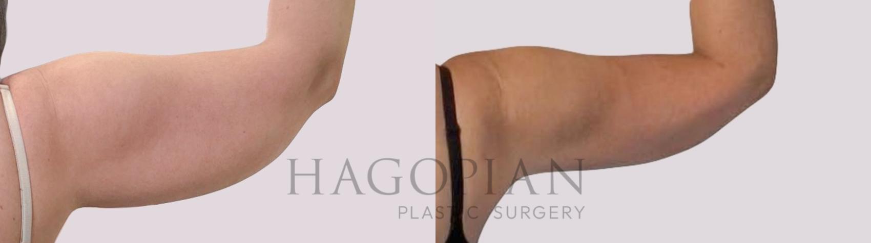 Before & After Arm Lift Case 290 Back Right View in Atlanta, GA