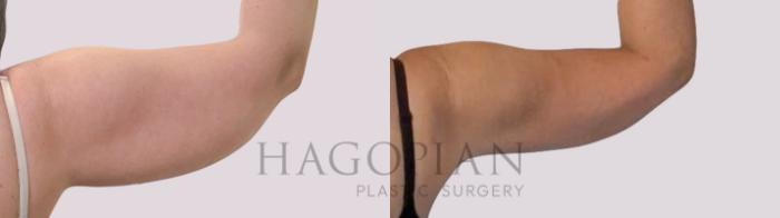 Before & After Arm Lift Case 290 Back Right View in Atlanta, GA