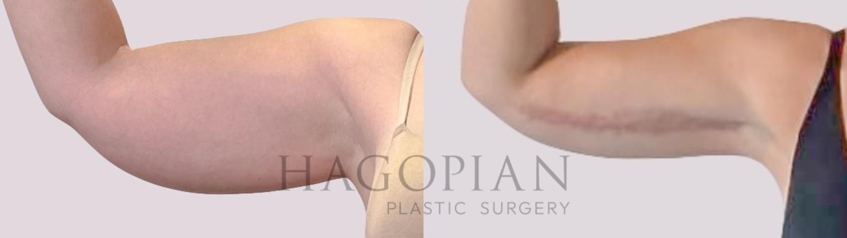 Before & After Arm Lift Case 290 Front Left View in Atlanta, GA
