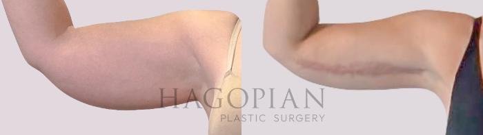 Before & After Arm Lift Case 290 Front Left View in Atlanta, GA