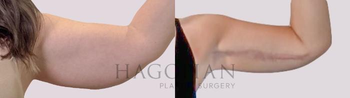 Before & After Arm Lift Case 290 Front Right View in Atlanta, GA