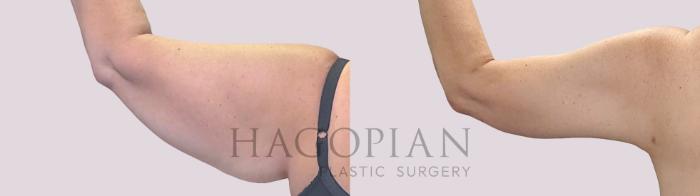 Before & After Arm Lift Case 300 Back Left View in Atlanta, GA