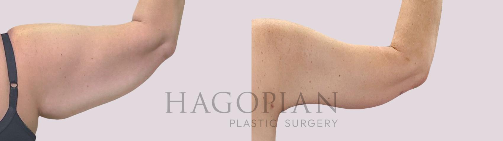 Before & After Arm Lift Case 300 Back Right View in Atlanta, GA