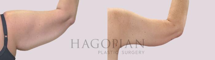 Before & After Arm Lift Case 300 Back Right View in Atlanta, GA