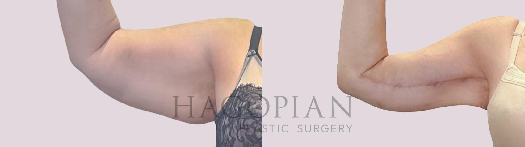 Before & After Arm Lift Case 300 Front Left View in Atlanta, GA