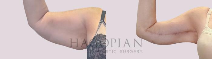 Before & After Arm Lift Case 300 Front Left View in Atlanta, GA