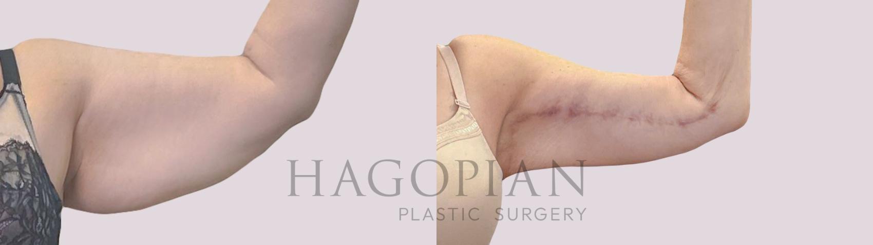 Before & After Arm Lift Case 300 Front Right View in Atlanta, GA