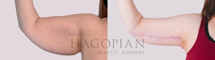 Before & After Arm Lift Case 303 Front Left View in Atlanta, GA