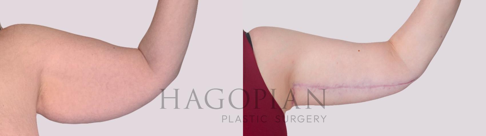 Before & After Arm Lift Case 303 Front Right View in Atlanta, GA