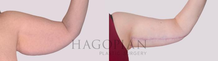 Before & After Arm Lift Case 303 Front Right View in Atlanta, GA