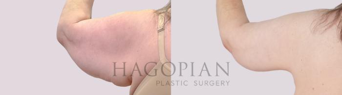Before & After Arm Lift Case 305 Back Left View in Atlanta, GA