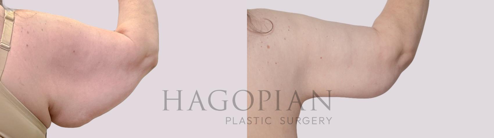 Before & After Arm Lift Case 305 Back Right View in Atlanta, GA