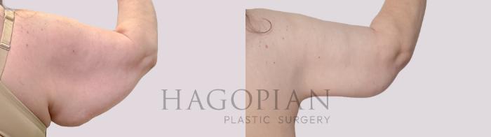 Before & After Arm Lift Case 305 Back Right View in Atlanta, GA