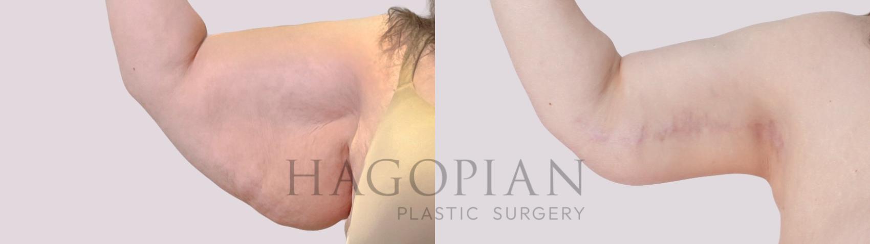 Before & After Arm Lift Case 305 Front Left View in Atlanta, GA