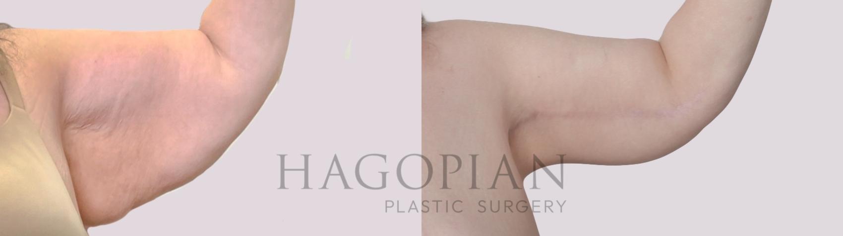 Before & After Arm Lift Case 305 Front Right View in Atlanta, GA