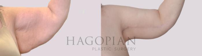 Before & After Arm Lift Case 305 Front Right View in Atlanta, GA