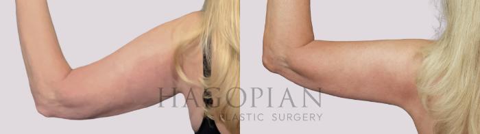 Before & After Arm Lift Case 33 Back Left View in Atlanta, GA