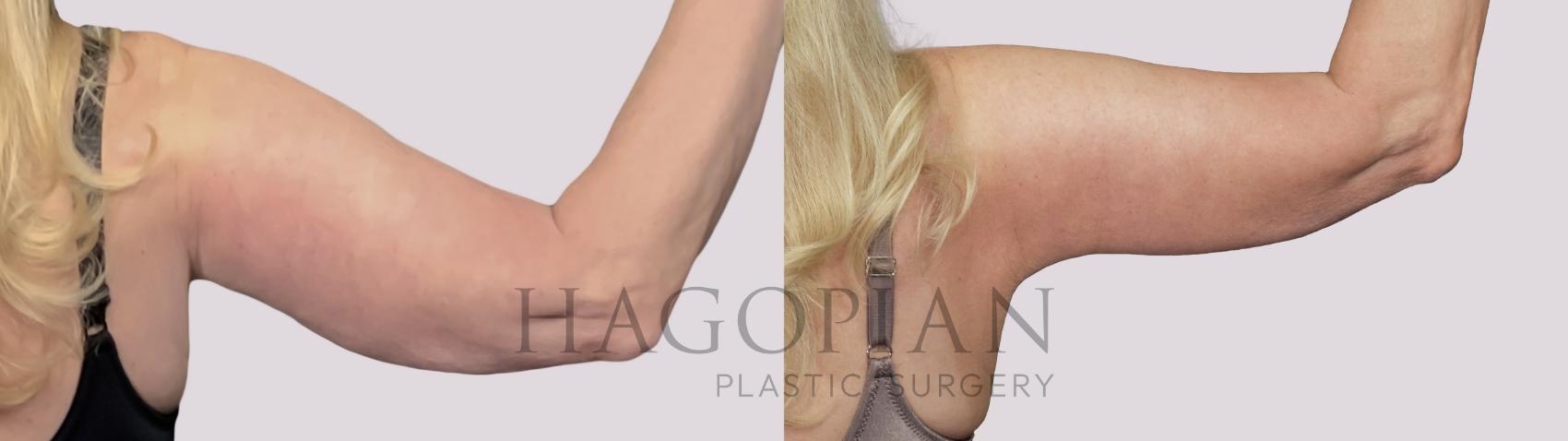 Before & After Arm Lift Case 33 Back Right View in Atlanta, GA
